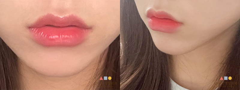 수술 후