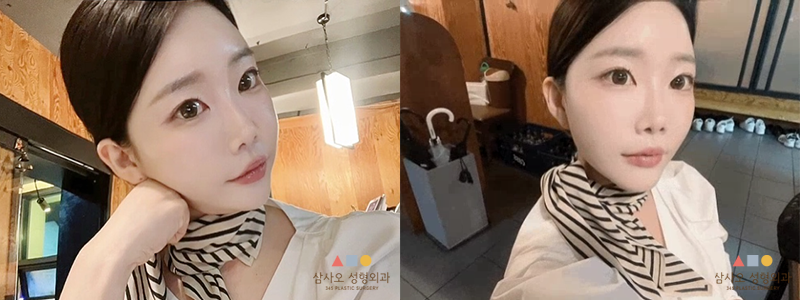 수술 후