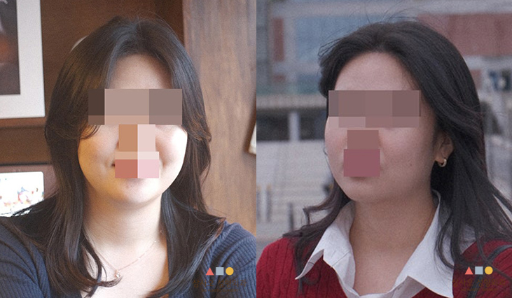 수술 전
