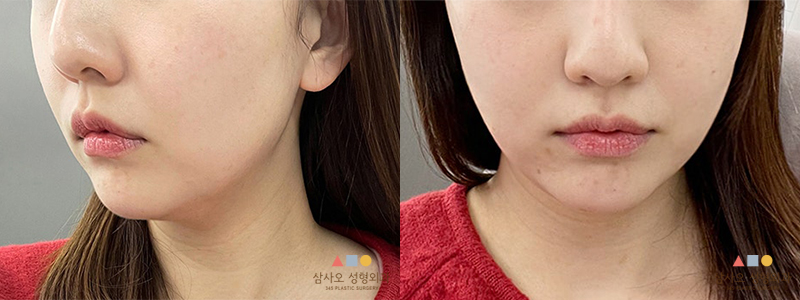 수술 후