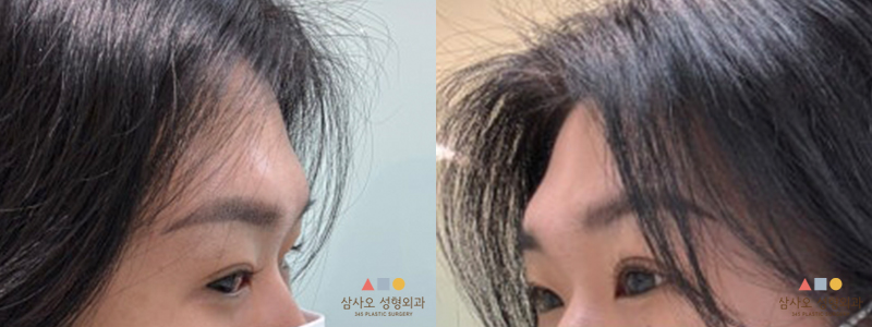 수술 전