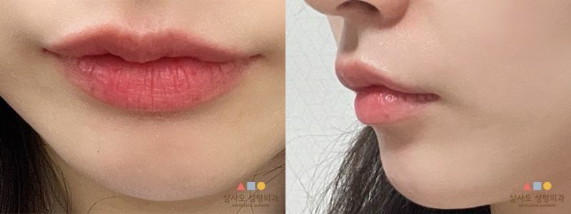 수술 전