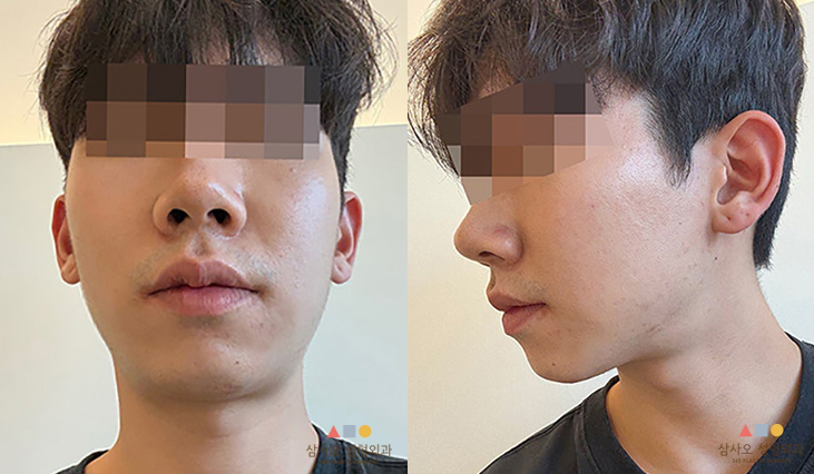수술 전