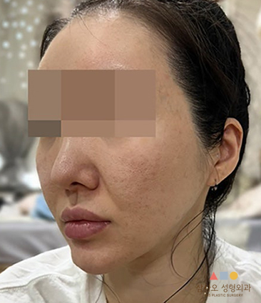 수술 전